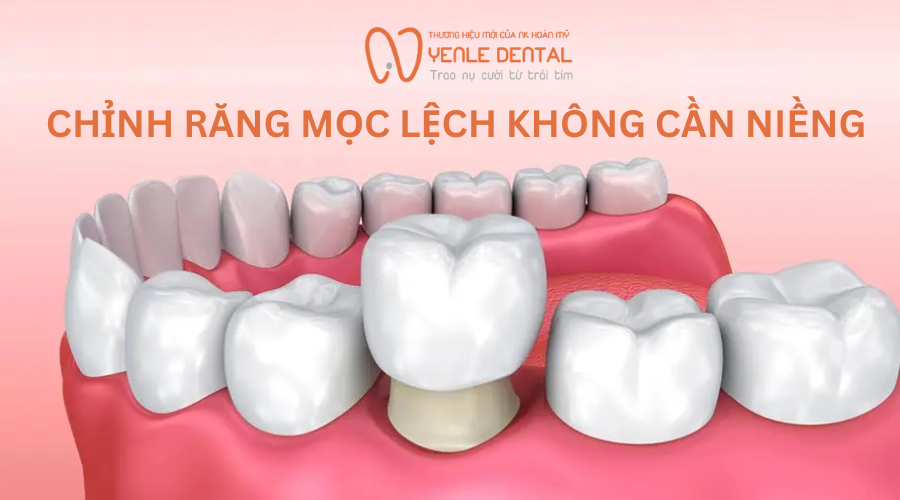 chỉnh răng không cần niềng